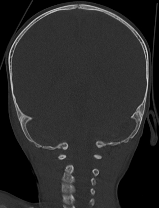 Acute mastoiditis (Radiopaedia 82678-96881 Coronal bone window 53).jpg
