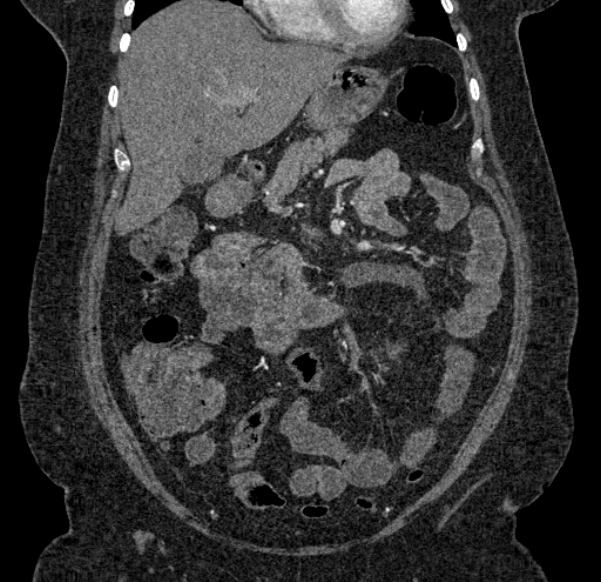 Acute mesenteric ischemia (Radiopaedia 80029-93316 Coronal C+ arterial phase 46).jpg