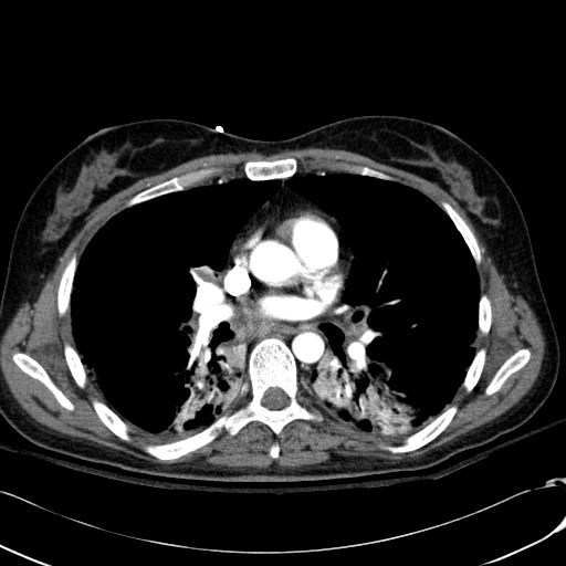 Acute myocardial infarction in CT (Radiopaedia 39947-42415 Axial C+ arterial phase 68).jpg