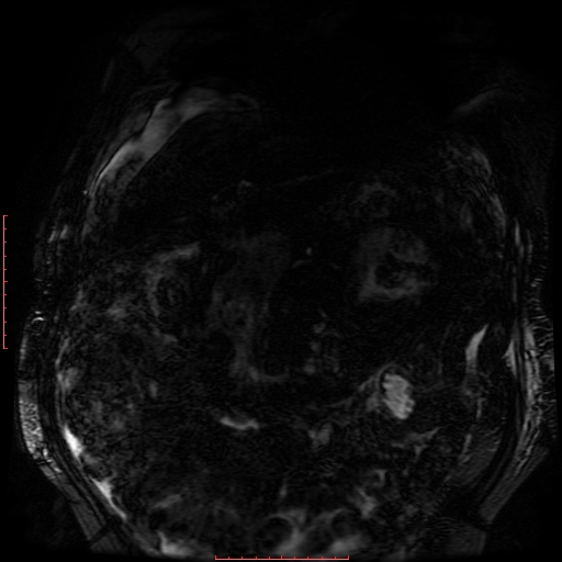 Acute necrotizing pancreatitis (Radiopaedia 28194-28448 Coronal MRCP 77).jpg