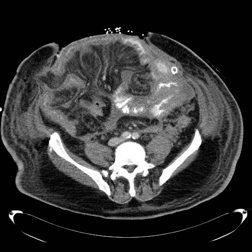 Acute pancreatic necrosis (Radiopaedia 13560-18503 Axial C+ portal venous phase 54).jpg