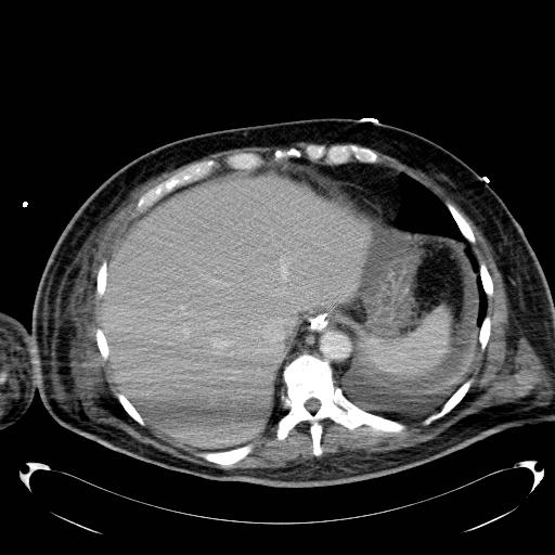 File:Acute pancreatic necrosis (Radiopaedia 13560-18503 Axial C+ portal venous phase 9).jpg