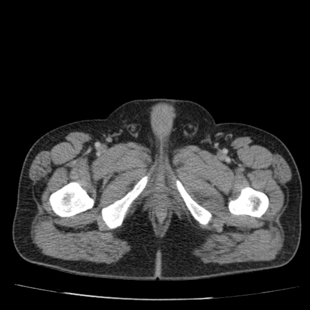 Acute pancreatitis (Radiopaedia 26663-26813 Axial C+ portal venous phase 93).jpg