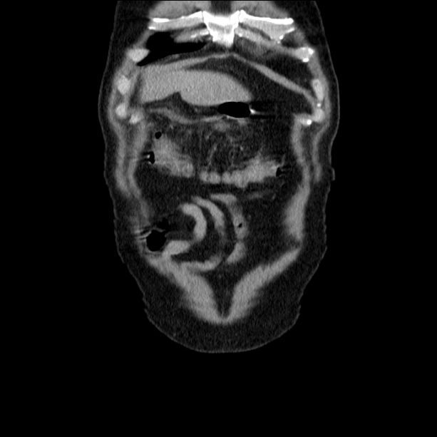 Acute pancreatitis (Radiopaedia 26663-26813 Coronal C+ portal venous phase 10).jpg
