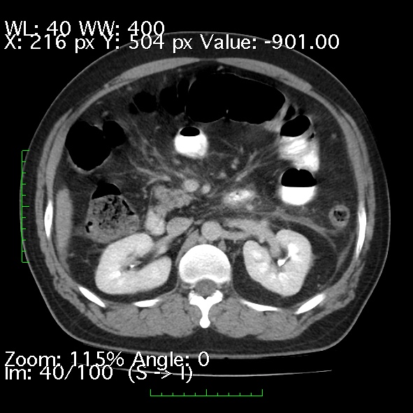 File:Acute pancreatitis (Radiopaedia 34043-35276 Axial C+ portal venous phase 40).jpg