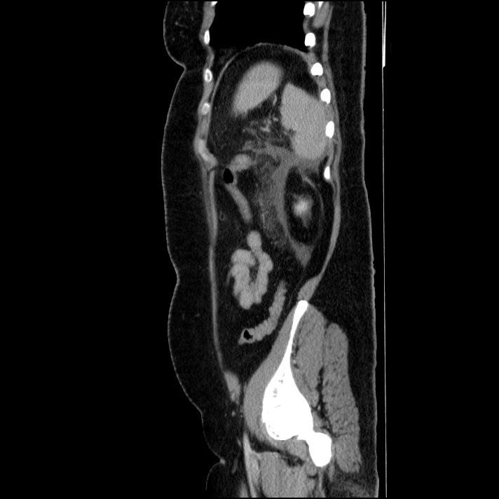 Acute pancreatitis (Radiopaedia 69236-79012 Sagittal C+ portal venous phase 28).jpg