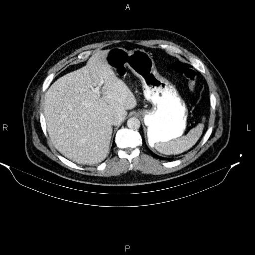 Acute pancreatitis (Radiopaedia 85390-101010 Axial C+ portal venous phase 20).jpg