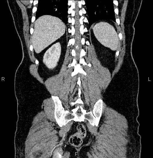Acute pancreatitis (Radiopaedia 85390-101010 Coronal C+ portal venous phase 60).jpg
