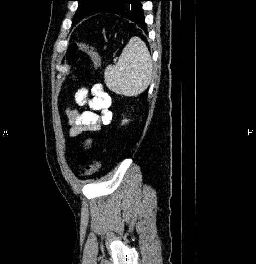 Acute pancreatitis (Radiopaedia 85390-101010 Sagittal C+ portal venous phase 91).jpg