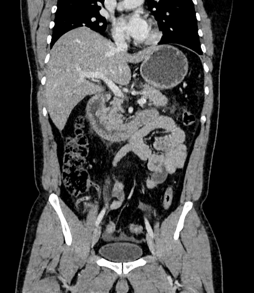 File:Acute pancreatitis (Radiopaedia 87428-103757 Coronal C+ portal venous phase 44).jpg