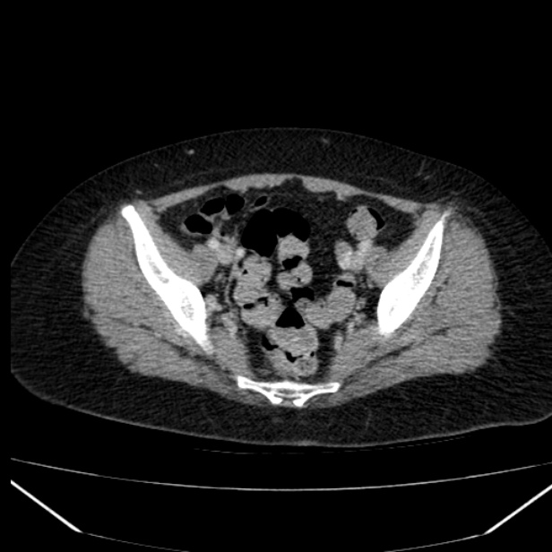 Acute pancreatitis - Balthazar C (Radiopaedia 26569-26714 Axial C+ portal venous phase 81).jpg