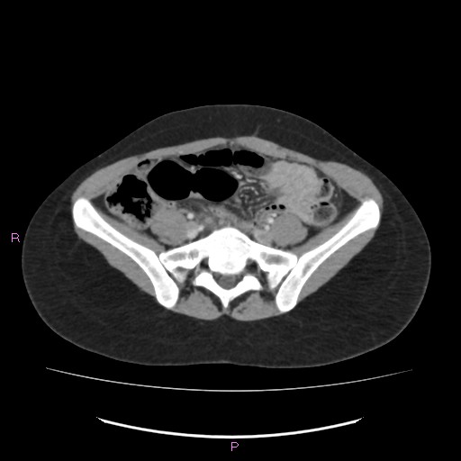 File:Acute pancreatitis secondary to stone at minor papilla and pancreatic divisum (Radiopaedia 76570-88333 Axial C+ portal venous phase 55).jpg