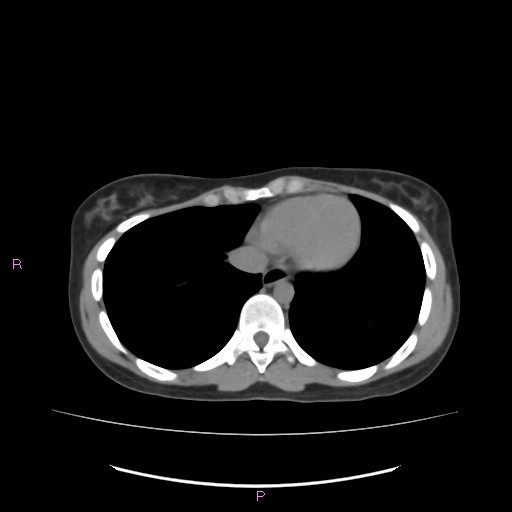 Acute pancreatitis secondary to stone at minor papilla and pancreatic divisum (Radiopaedia 76570-88333 Axial non-contrast 5).jpg