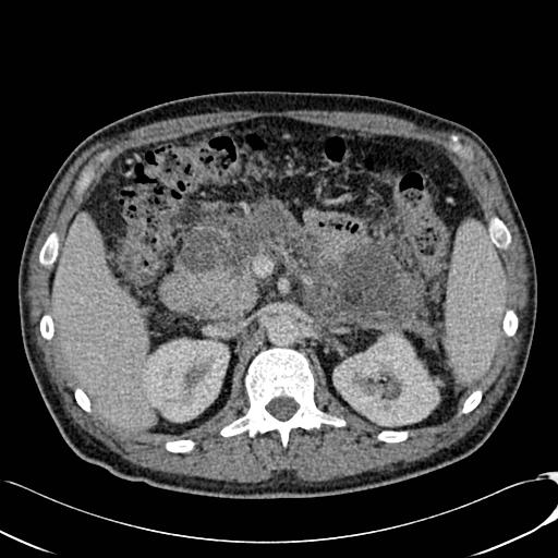File:Acute pancreatitis with walled off pancreatic necrosis (Radiopaedia 6438-7797 Axial C+ portal venous phase 7).jpg