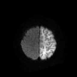 File:Acute phase of hemiconvulsion-hemiplegia epilepsy syndrome (Radiopaedia 29309-29745 Axial DWI 19).jpg