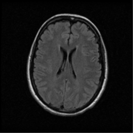 File:Acute pontine infarct from vertebral artery dissection (Radiopaedia 34111-35370 Axial FLAIR 13).png
