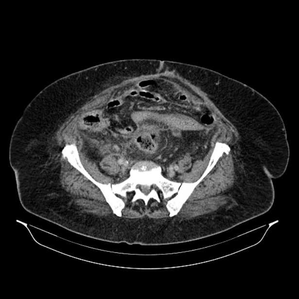 Acute pyelonephritis (Radiopaedia 25657-25837 Axial renal parenchymal phase 59).jpg