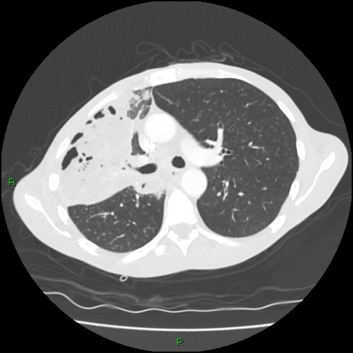 Acute right lung abscess (Radiopaedia 34806-36258 Axial lung window 74).jpg