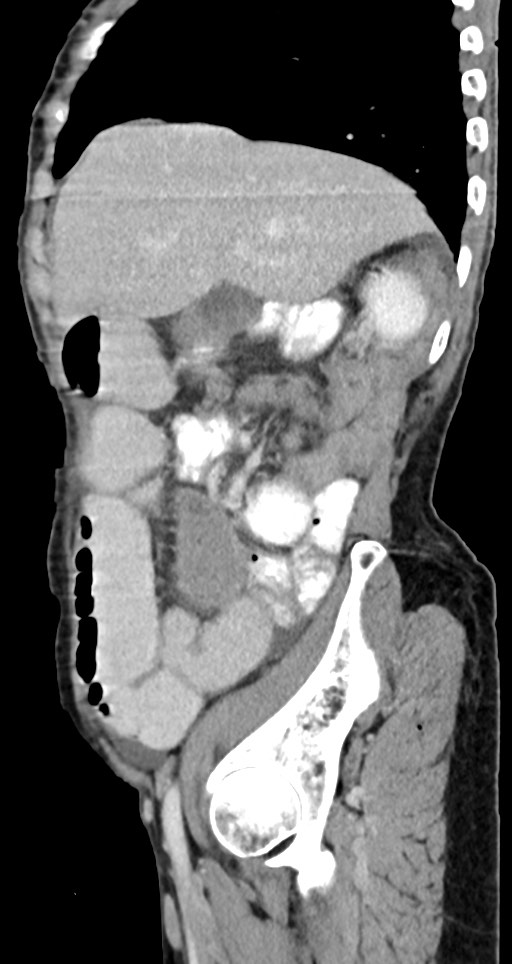 Acute small bowel (ileal) volvulus (Radiopaedia 71740-82139 Sagittal C+ portal venous phase 120).jpg