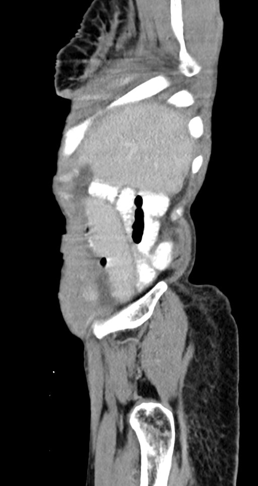 Acute small bowel (ileal) volvulus (Radiopaedia 71740-82139 Sagittal C+ portal venous phase 142).jpg