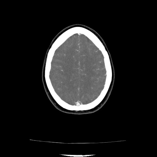 File:Acute subarachnoid hemorrhage and accessory anterior cerebral artery (Radiopaedia 69231-79009 Axial C+ arterial phase 113).jpg