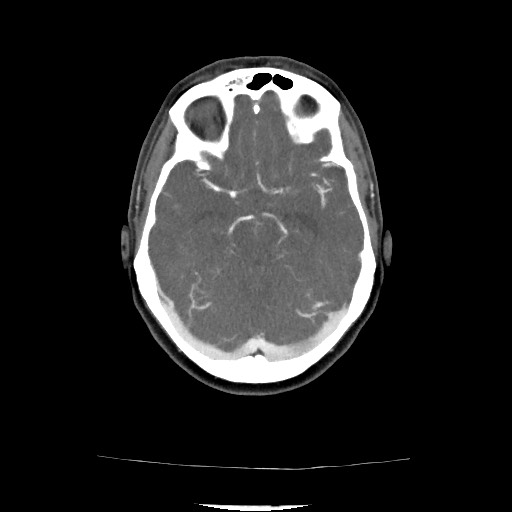 Acute subarachnoid hemorrhage and accessory anterior cerebral artery (Radiopaedia 69231-79009 Axial C+ arterial phase 91).jpg