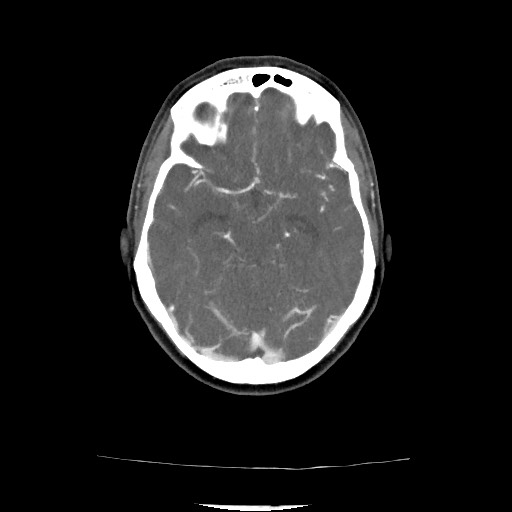 Acute subarachnoid hemorrhage and accessory anterior cerebral artery (Radiopaedia 69231-79009 Axial C+ arterial phase 92).jpg