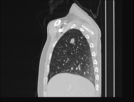 Addison disease (Radiopaedia 49318-54412 Sagittal lung window 51).jpg