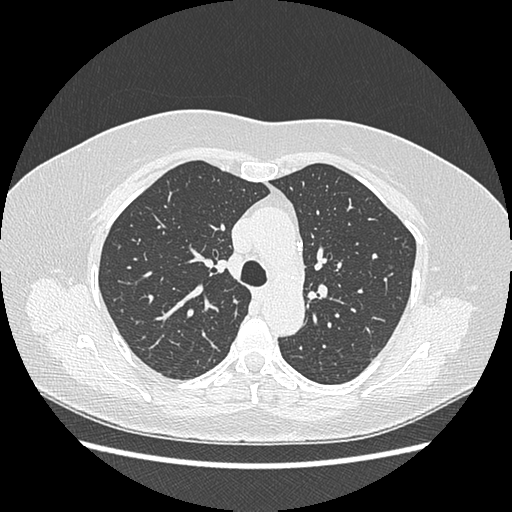 Adenocarcinoma in situ of lung (Radiopaedia 38685-40829 B 79).png