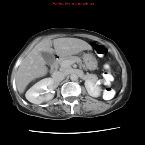 Adenocarcinoma of the colon (Radiopaedia 8191-9039 Axial renal excretory phase 13).jpg