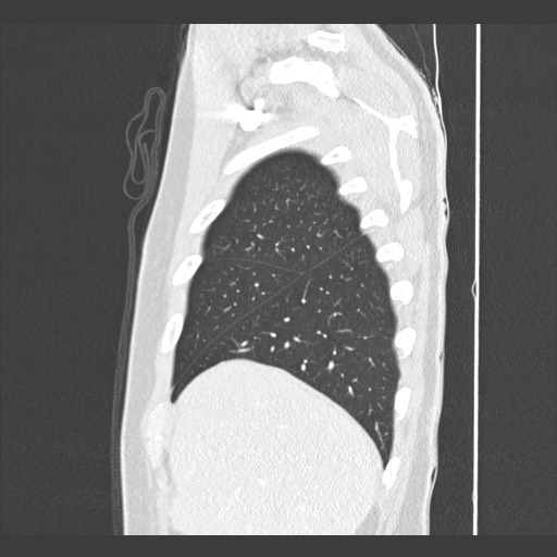 Adenocarcinoma of the lung (Radiopaedia 59871-67325 Sagittal lung window 13).jpg