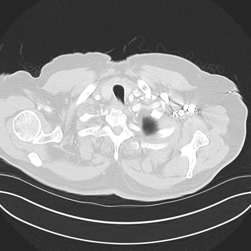 Adenocarcioma of rectum- T1 lesion (Radiopaedia 36921-38547 Axial lung window 7).png