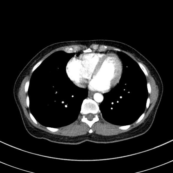 File:Adenocystic carcinoma of the trachea (Radiopaedia 47677-52525 Axial C+ arterial phase 64).jpg