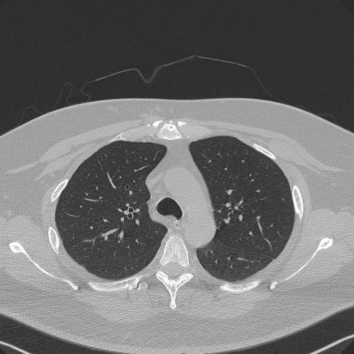 Adenoid cystic carcinoma of the trachea (Radiopaedia 49042-54137 Axial lung window 102).jpg
