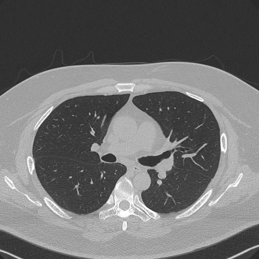 Adenoid cystic carcinoma of the trachea (Radiopaedia 49042-54137 Axial lung window 151).jpg