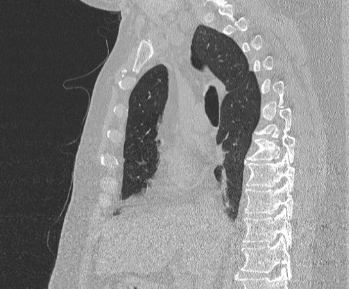 Adenoid cystic carcinoma of the trachea (Radiopaedia 49042-54137 Sagittal lung window 209).jpg