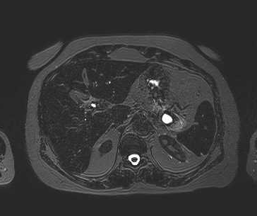 File:Adenomyomatosis of the gallbladder (Radiopaedia 50246-55587 Axial 79).png