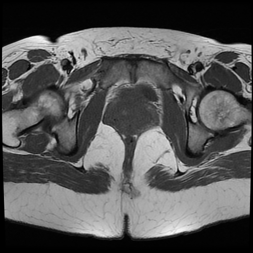 File:Adenomyosis-scar endometriosis (Radiopaedia 65863-75022 Axial T1 26).jpg