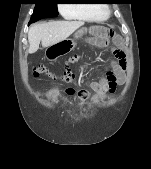 Adhesions within abdominal wall hernia (Radiopaedia 58283-65394 Coronal C+ portal venous phase 21).png