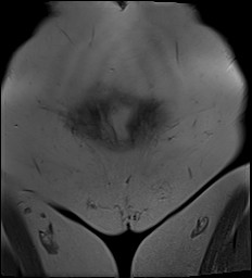 File:Adnexal multilocular cyst (O-RADS US 3- O-RADS MRI 3) (Radiopaedia 87426-103754 Sagittal T2 24).jpg
