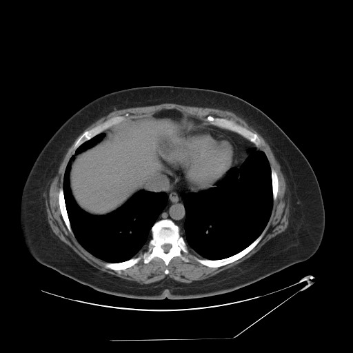 Adrenal angiosarcoma (Radiopaedia 81081-94671 Axial non-contrast 7).jpg