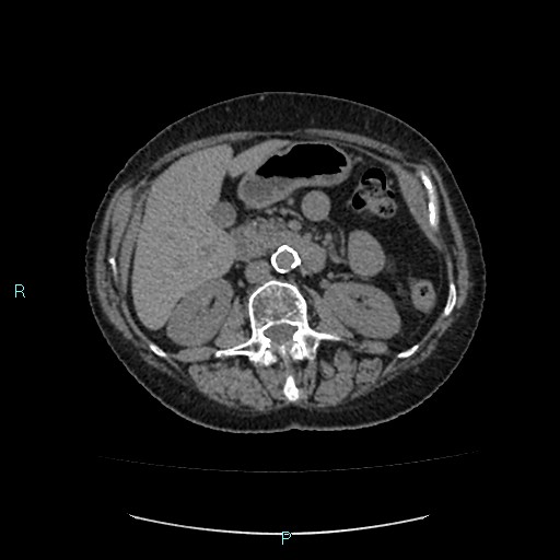 File:Adrenal collision tumor (ACT) (Radiopaedia 48462-53379 Axial non-contrast 25).jpg