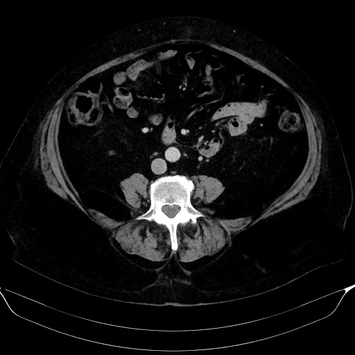 File:Adrenal cortical carcinoma (Radiopaedia 64017-72769 Axial C+ portal venous phase 42).jpg