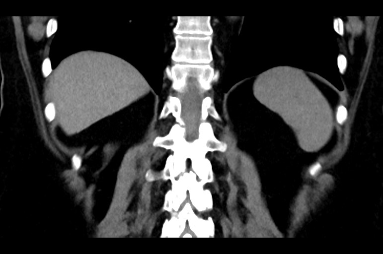 Adrenal cortical carcinoma (Radiopaedia 64017-72769 Coronal non-contrast 44).jpg