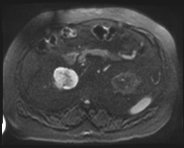 Adrenal cortical carcinoma (Radiopaedia 64017-72770 Axial DWI 105).jpg