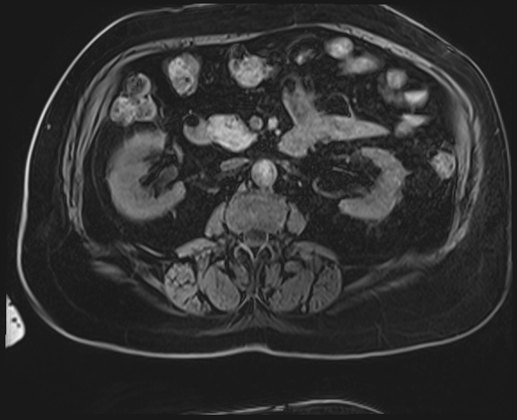 Adrenal cortical carcinoma (Radiopaedia 64017-72770 Axial T1 C+ fat sat 26).jpg