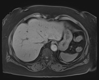 Adrenal cortical carcinoma (Radiopaedia 64017-72770 Axial T1 fat sat 9).jpg
