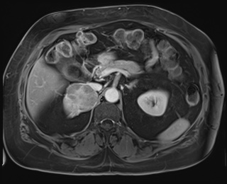 Adrenal cortical carcinoma (Radiopaedia 64017-72770 K 32).jpg