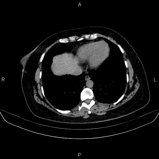 File:Adrenal cortical carcinoma (Radiopaedia 84882-100379 Axial non-contrast 7).jpg