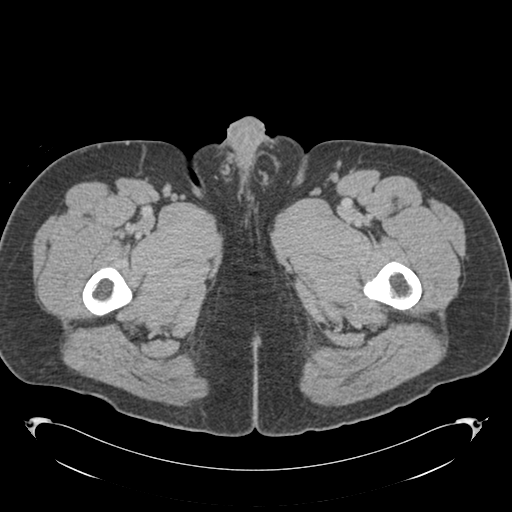 File:Adrenal cyst (Radiopaedia 45625-49776 Axial C+ portal venous phase 111).png